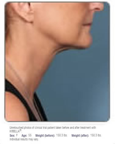 kybella results after